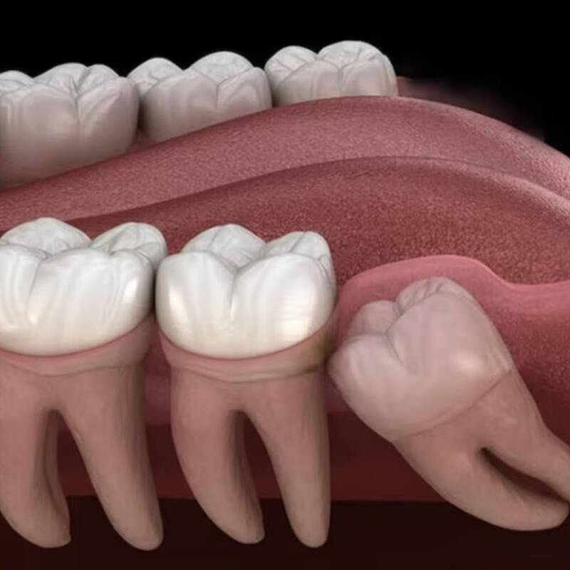 Finalmente, las muelas de juicio sirven para algo