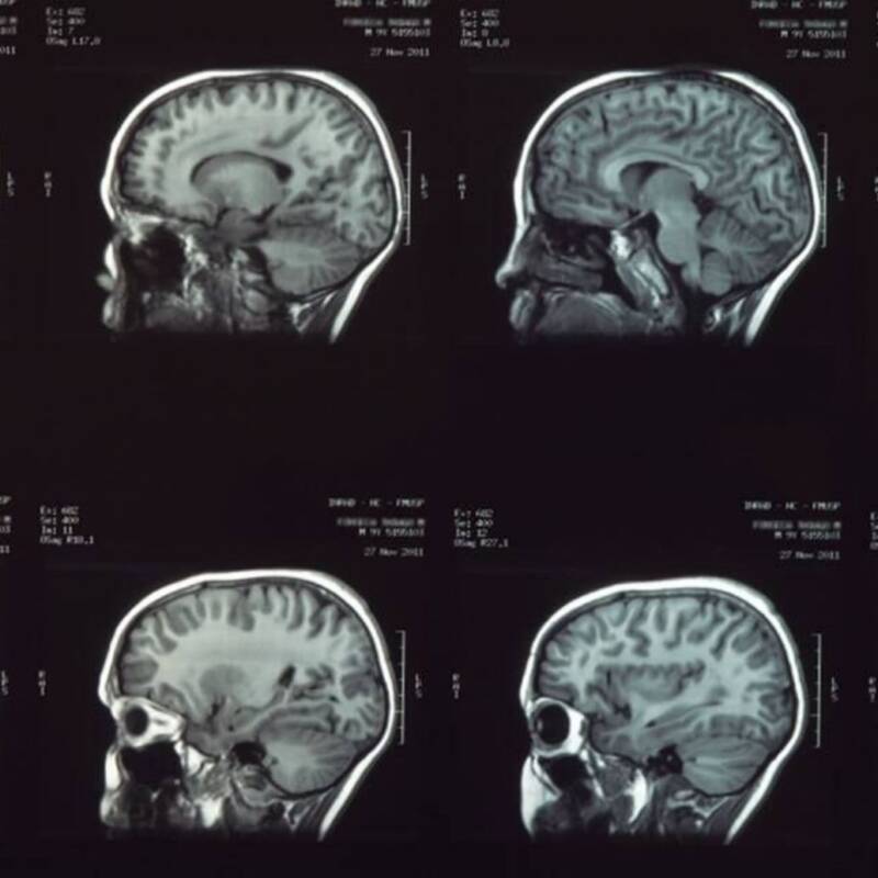 La evolución del cerebro en la adolescencia y su impacto en la toma de decisiones