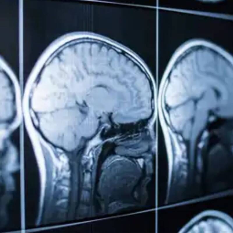 Nuevo estudio investigará implantes cerebrales con ultrasonido