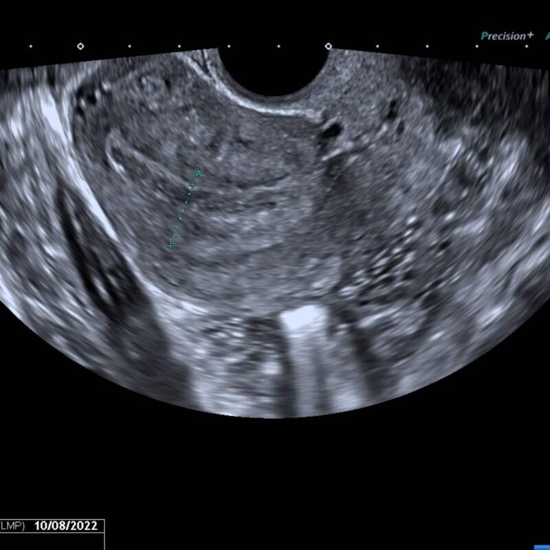 Todo lo que tenés que saber sobre los embarazos ectópicos
