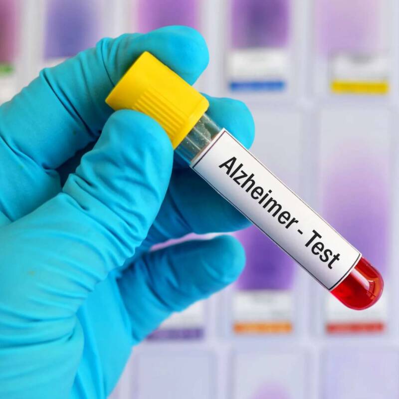 Un análisis de sangre podría ser suficiente para diagnosticar el Alzheimer en etapas tempranas, según un estudio
